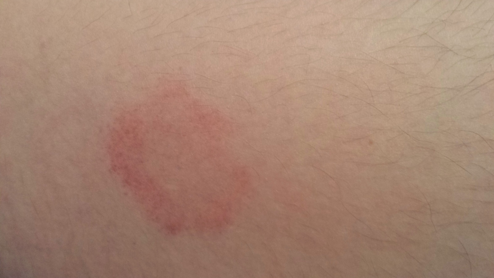 Seit mehreren Tagen merkwürdiger roter Fleck auf Oberschenkel Seit mehreren Tagen merkwürdiger roter Fleck auf Oberschenkel