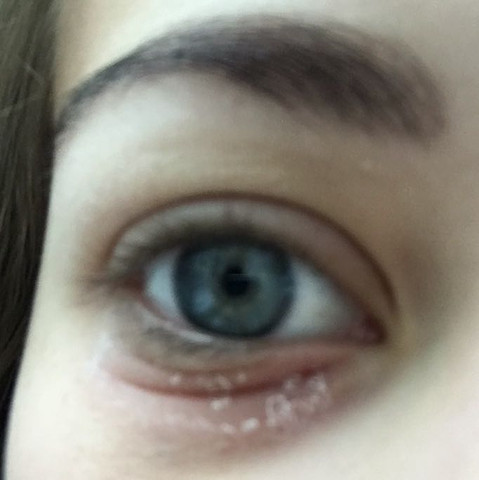 Seit Monaten Trockenes Rotes Augenlid Entzundung Trockene Haut