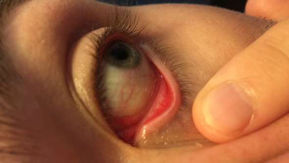 Seit Wochen Aderchen Im Auge Verschwommene Sicht Augen Augenarzt Seit Wochen Aderchen Im Auge Verschwommene Sicht Augen Augenarzt
