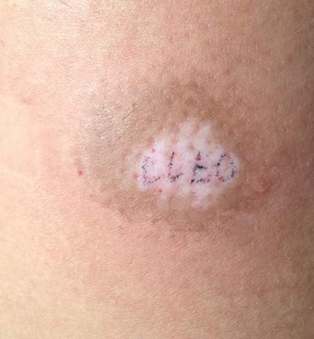 Selbst Gemachtes Tattoo Alleine Entfernt Narben Tatowieren Tattoopflege Selbst Gemachtes Tattoo Alleine Entfernt Narben Tatowieren Tattoopflege