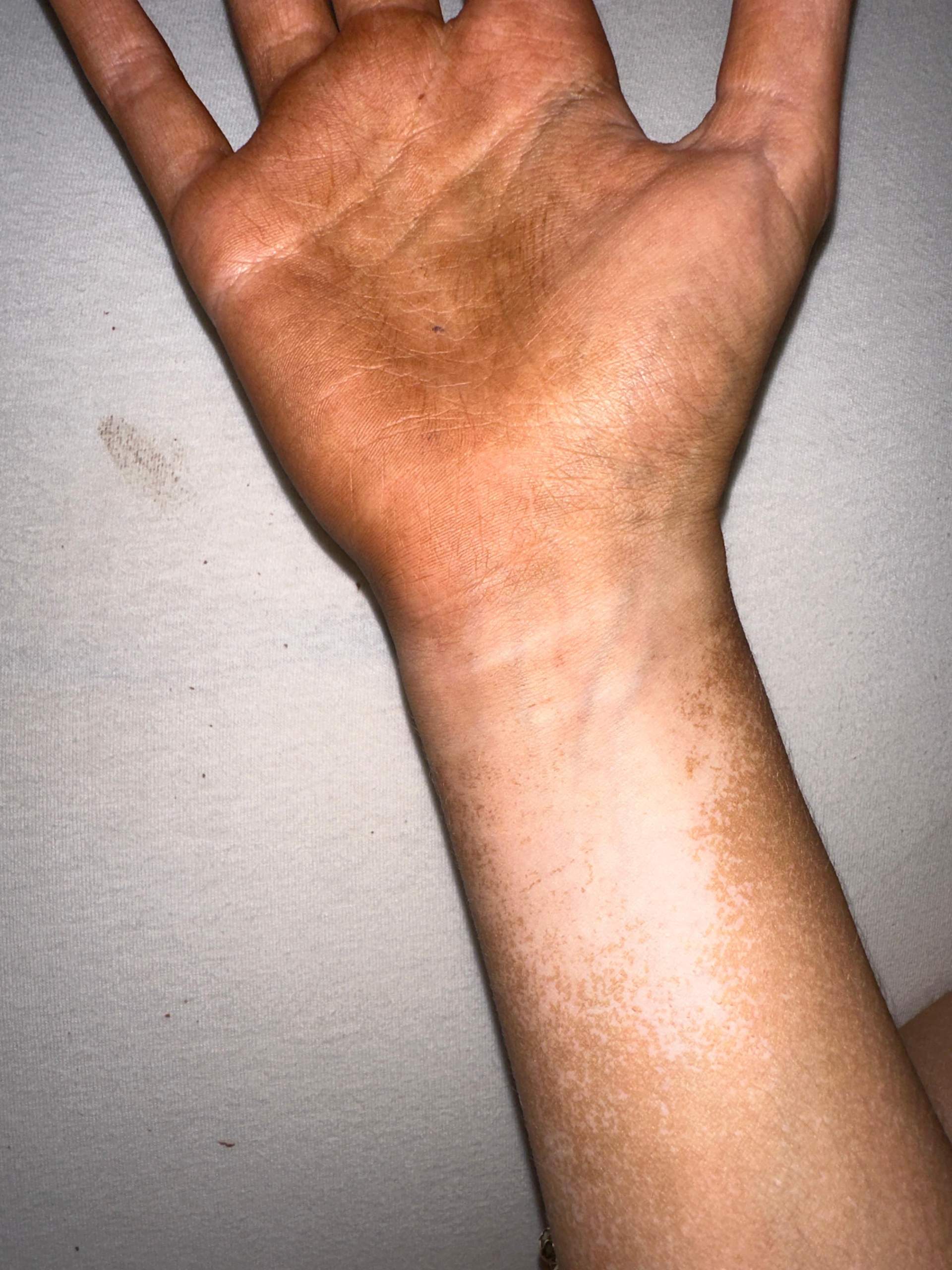 Selbstbräuner flecken wegmachen? (Haut, Sonne, Solarium)