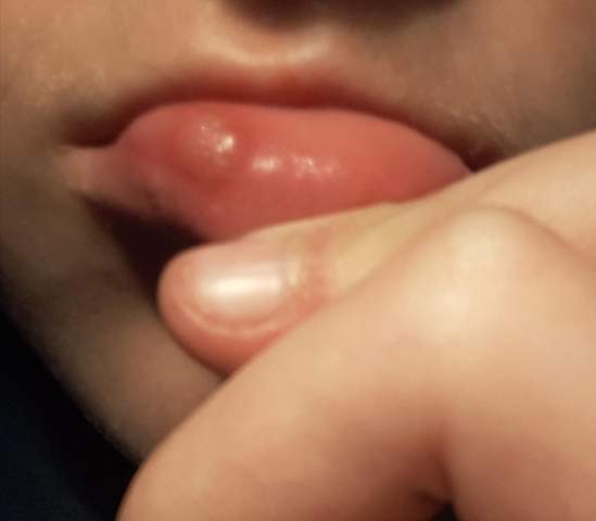 Seltsame Beule An Der Lippe Gesundheit Und Medizin Seltsame Beule An Der Lippe Gesundheit Und Medizin