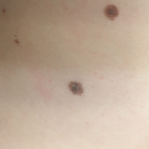 Download Was ist muttermal HD Was Ist Muttermal