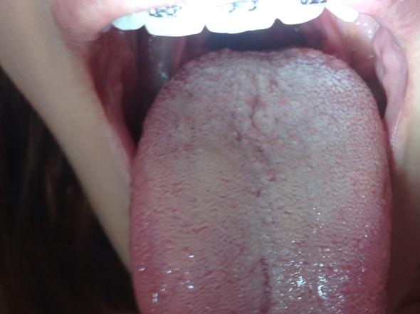 44+ Pickel Auf Der Zunge Hinten Kinder Images