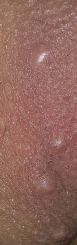 Seltsame Pickeln Im Intimbereich Normale Pickel Dellwarze Intim Seltsame Pickeln Im Intimbereich Normale Pickel Dellwarze Intim