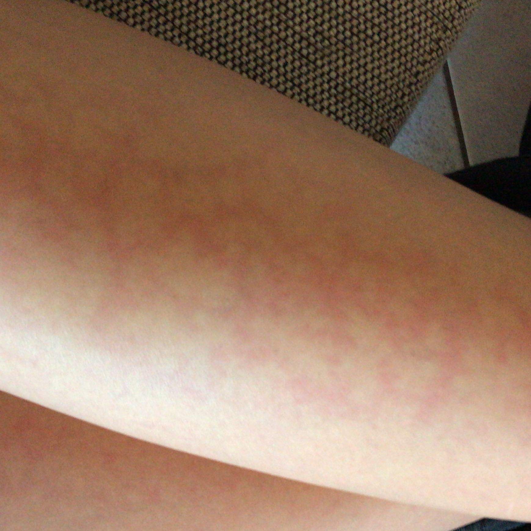 Seltsame Rote Flecken Auf Den Oberschenkeln Sonne Hautprobleme Hautirritation Seltsame Rote Flecken Auf Den Oberschenkeln Sonne Hautprobleme Hautirritation