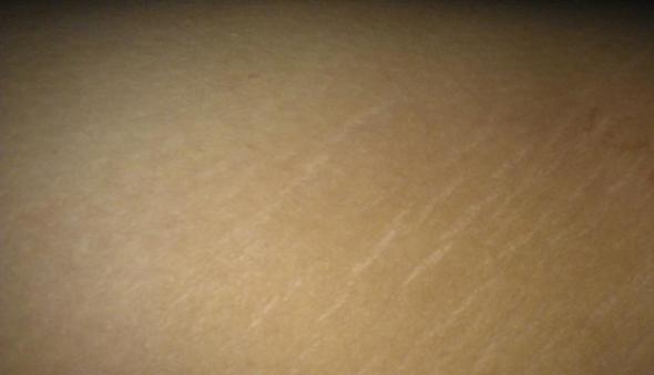 Seltsame Streifen Auf Den Oberschenkeln Haut Beine Narben