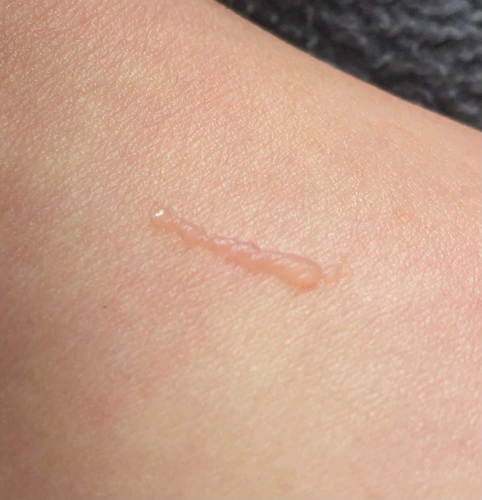 seltsame wasserblase am bein? (Gesundheit und Medizin, Gesundheit, Angst)