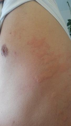 Seltsamer Ausschlag Plotzlich Aufgetreten Bilder Anbei Allergie Juckreiz Infektion Seltsamer Ausschlag Plotzlich Aufgetreten Bilder Anbei Allergie Juckreiz Infektion
