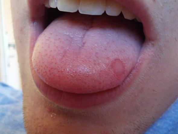 Zunge mit Fleck - (Gesundheit, Mund, Zunge)