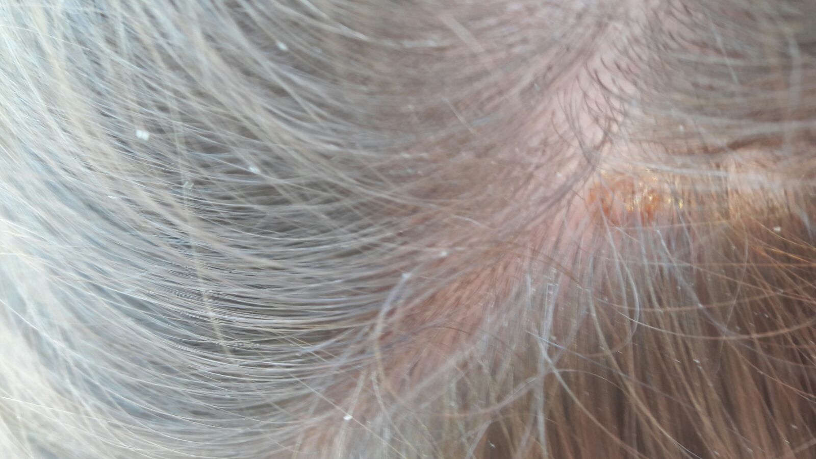 Seltsamer roter Punkt auf Kopfhaut? (Medizin, Foto, Pickel) pickel auf kopfhaut