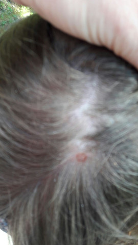 Seltsamer Roter Punkt Auf Kopfhaut Medizin Foto Pickel