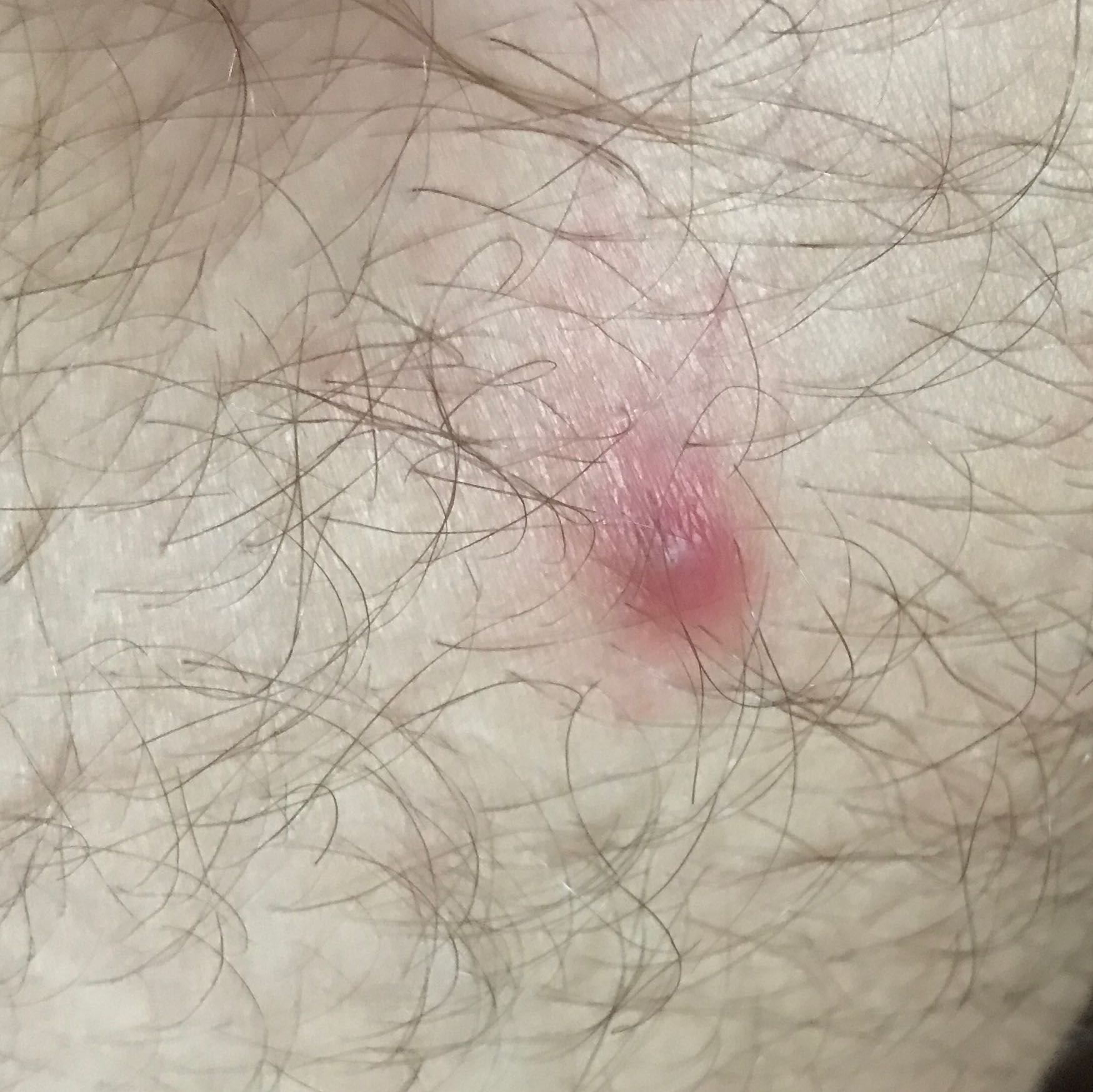 Seltsamer schmerzhafter Pickel am Oberschenkel? (Gesundheit, Arzt, Schmerzen)