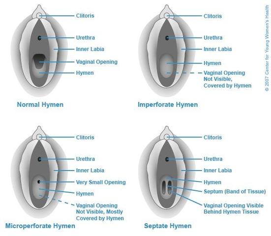 Septales Hymen (Gesundheit, Frauen, Medizin)