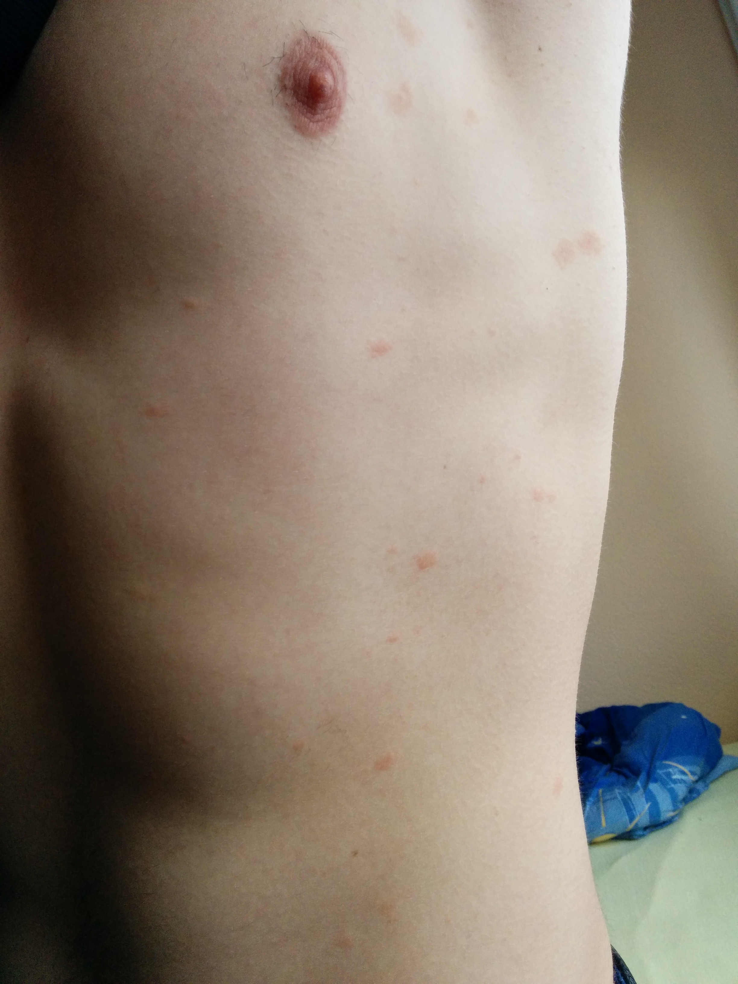 Sich ausbreitende rote Flecken auf der Haut… (Krankheit, Allergie, Pilze) Sich ausbreitende rote Flecken auf der Haut… (Krankheit, Allergie, Pilze)