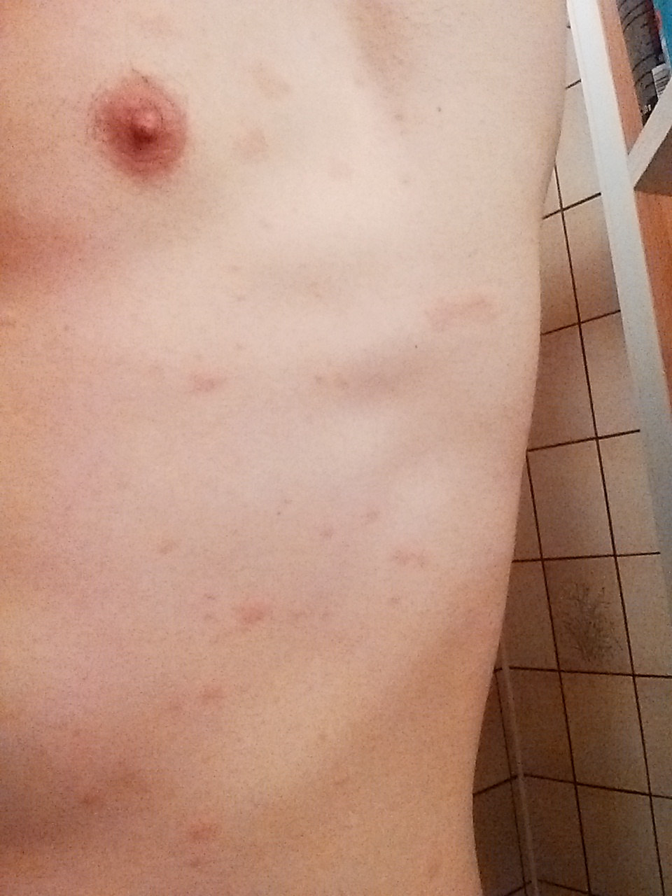 50+ Flecken auf der haut bilder , Sich ausbreitende rote Flecken auf der Haut... (Krankheit, Allergie, Pilze)