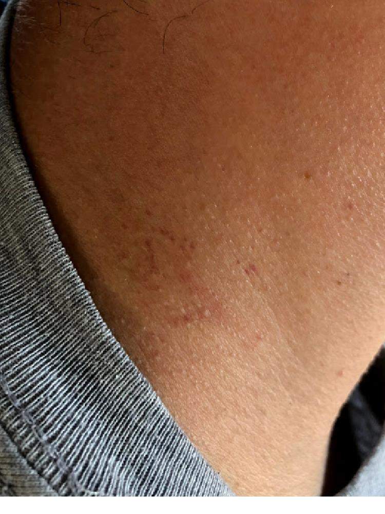 Sieht aus wie ein Knutschfleck? (Liebe)