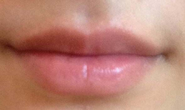 - (Gesundheit, Herpes)