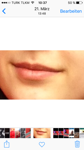 - (Gesundheit, Herpes)