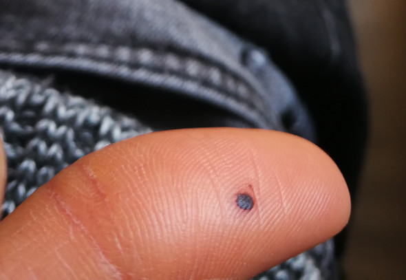 Sieht das aus wie ein Bluterguss? (Hautarzt, Hautprobleme)