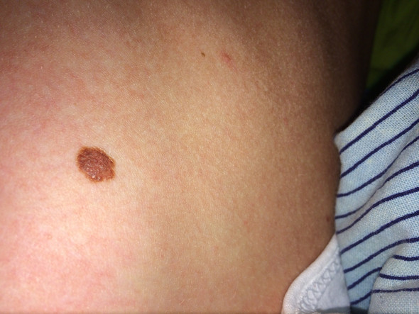 Sieht Das Aus Wie Hautkrebs Hilfe Gesundheit Und Medizin Hautarzt Sieht Das Aus Wie Hautkrebs Hilfe Gesundheit Und Medizin Hautarzt