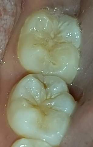 Sieht Das Aus Wie Karies Ist Das Karies Zahne Sieht Das Aus Wie Karies Ist Das Karies Zahne