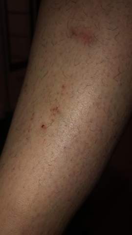 Sieht Das Aus Wie Scabies Gesundheit Und Medizin Gesundheit Aussehen Sieht Das Aus Wie Scabies Gesundheit Und Medizin Gesundheit Aussehen