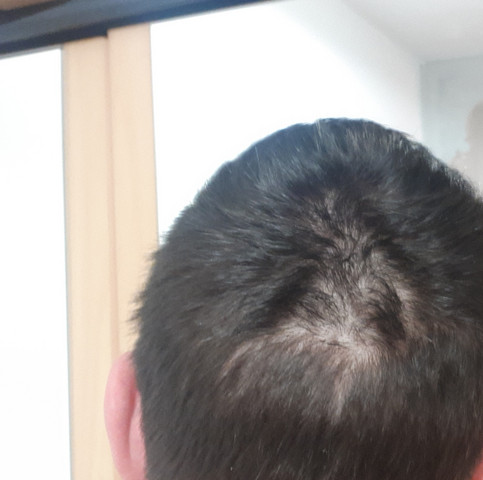 - (Gesundheit, Gesundheit und Medizin, Haare)