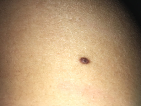 Sieht Das Muttermal Gefahrlich Aus Wegen Dem Einen Dunklen Punkt In Der Mitte Haut Krebs Hautkrebs Sieht Das Muttermal Gefahrlich Aus Wegen Dem Einen Dunklen Punkt In Der Mitte Haut Krebs Hautkrebs