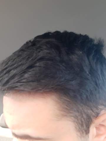 Sieht Das Nach Anfanglichem Haarausfall Aus Gesundheit Und Medizin Gesundheit Haare Sieht Das Nach Anfanglichem Haarausfall Aus Gesundheit Und Medizin Gesundheit Haare