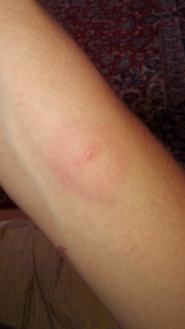 Sieht Das Nach Borreliose Gesundheit Und Medizin Zecke Zeckenbiss Sieht Das Nach Borreliose Gesundheit Und Medizin Zecke Zeckenbiss