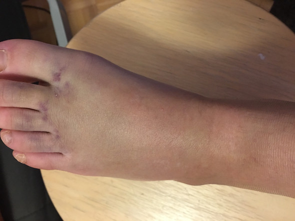 Sieht Das Nach Einem Banderriss Aus Umgeknickt