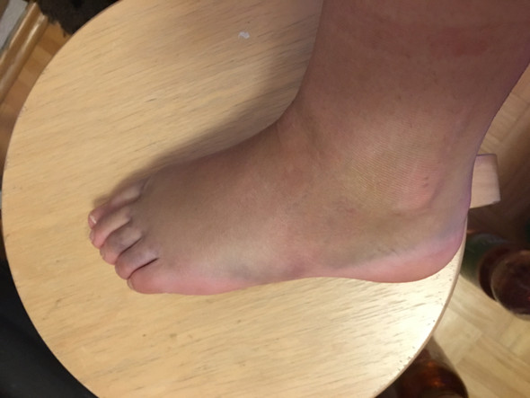 Sieht Das Nach Einem Banderriss Aus Umgeknickt