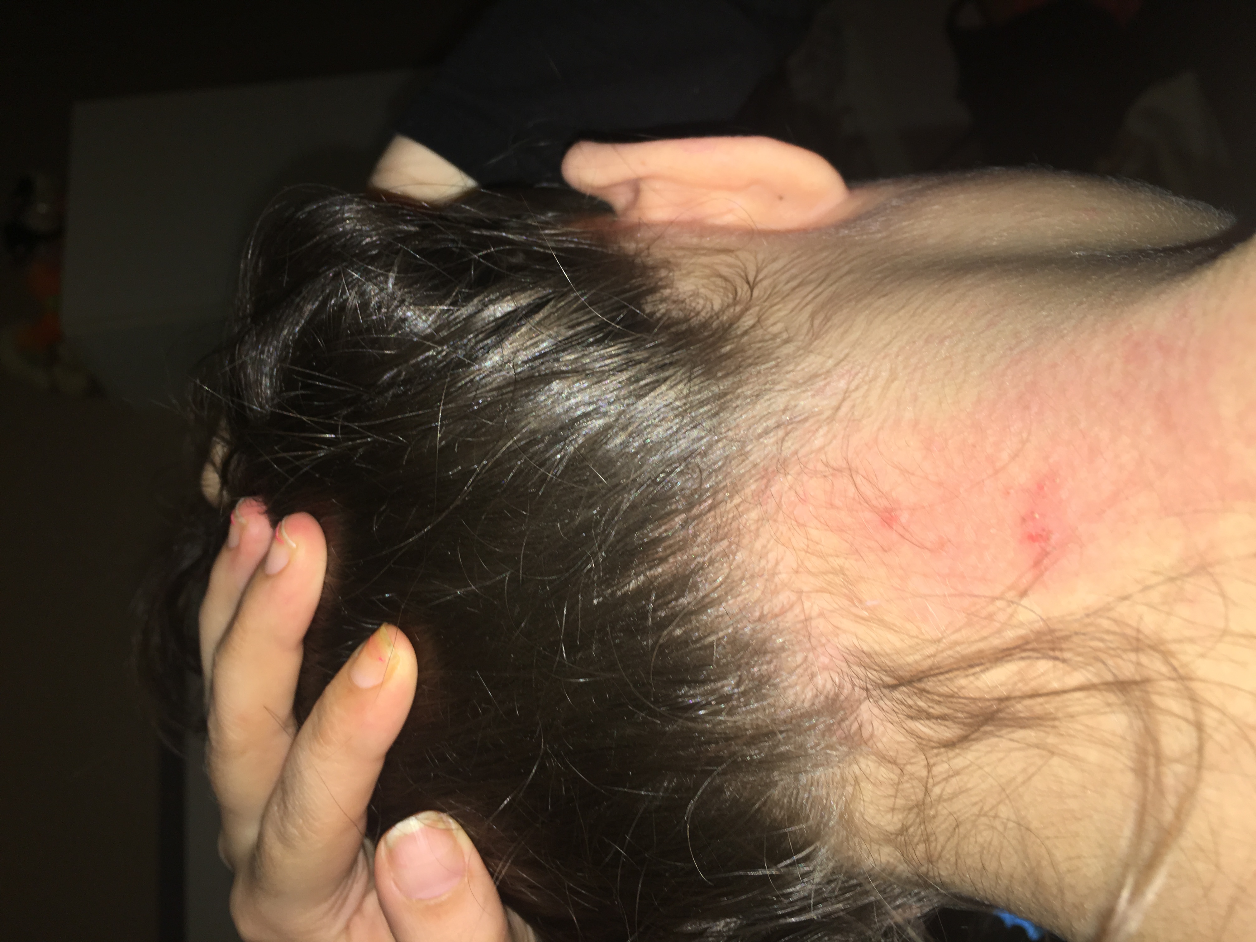 Sieht das nach einem fledermaus Biss aus ? (Wunde)