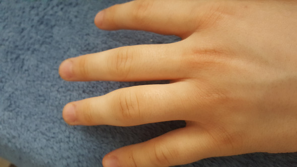 Kapselriss finger 