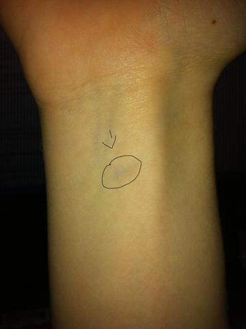 Sieht Das Nach Einer Blutvergiftung Aus Gesundheit Medizin Korper Sieht Das Nach Einer Blutvergiftung Aus Gesundheit Medizin Korper