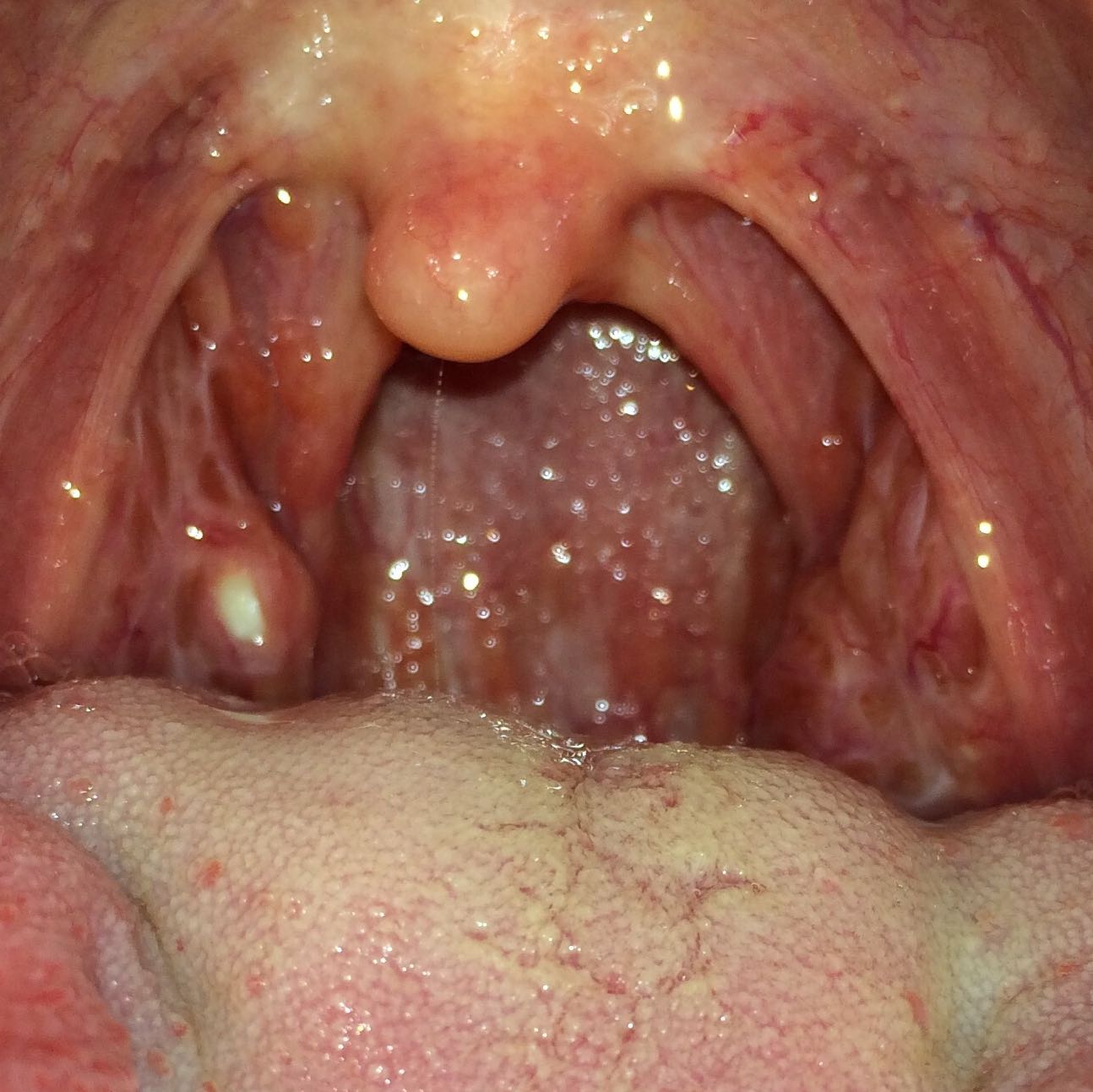 35+ Mund und rachenkrebs bilder , Sieht das nach einer Mandelentzündung aus? (Entzündung, Mandeln)