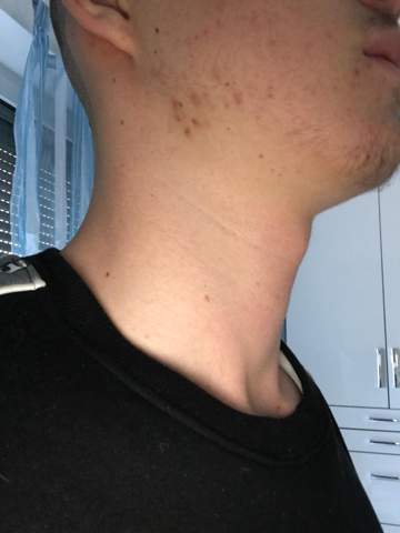 Sieht das nach einer vergrößerten Schilddrüse aus? (Gesundheit und Medizin)