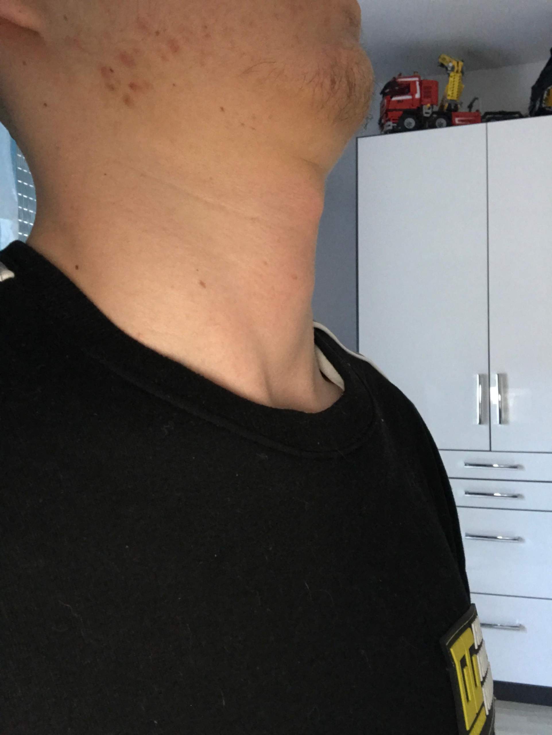 Wie Sieht Eine Vergrößerte Schilddrüse Aus