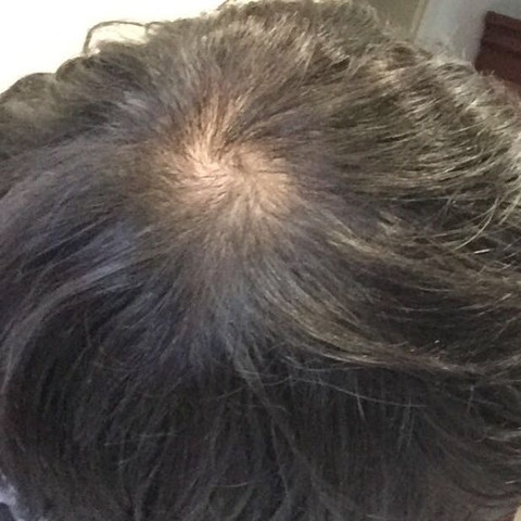 haarausfall aus oder ist das ein wiebe