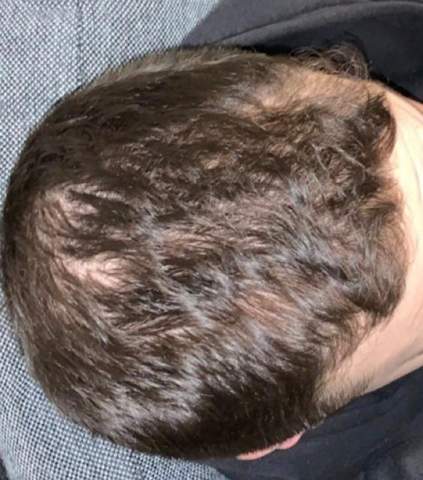 sieht das nach haarausfall aus mann