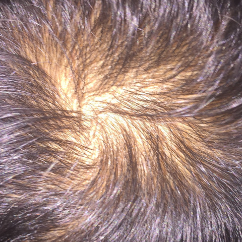 So siehts aus wenn ich meine haare nach vorne kemme und der wirbel sichtbar wird - (Haare, Licht, Geheimratsecken)