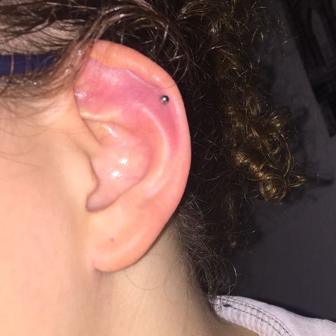 Sieht Das Ohr Normal Aus Vor 3 en Helix Piercing Gestochen Entzundung