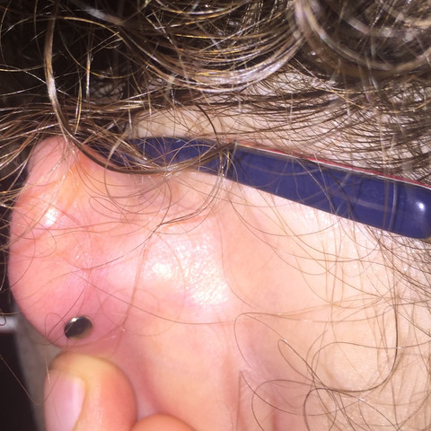 Sieht Das Ohr Normal Aus Vor 3 en Helix Piercing Gestochen Entzundung