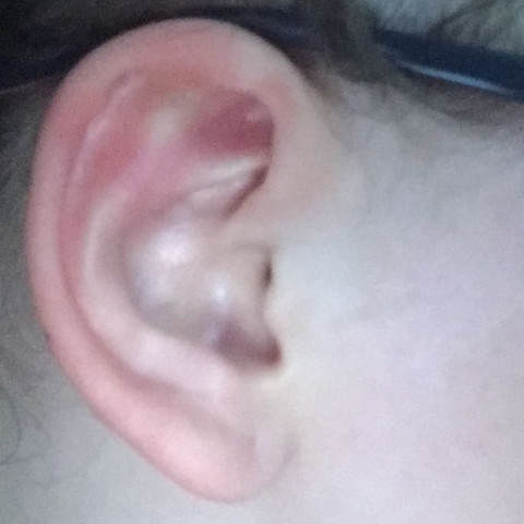 Sieht Das Ohr Normal Aus Vor 3 en Helix Piercing Gestochen Entzundung