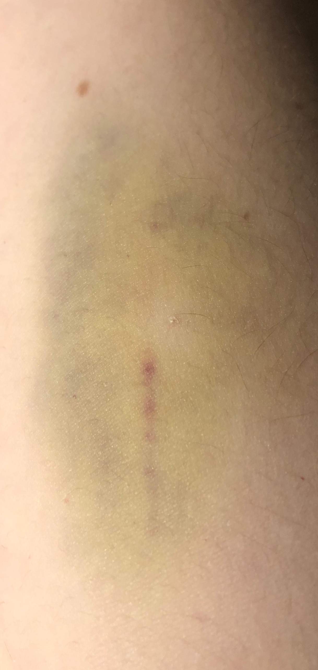 Wie Sieht Eine Blutvergiftung Aus Bilder
