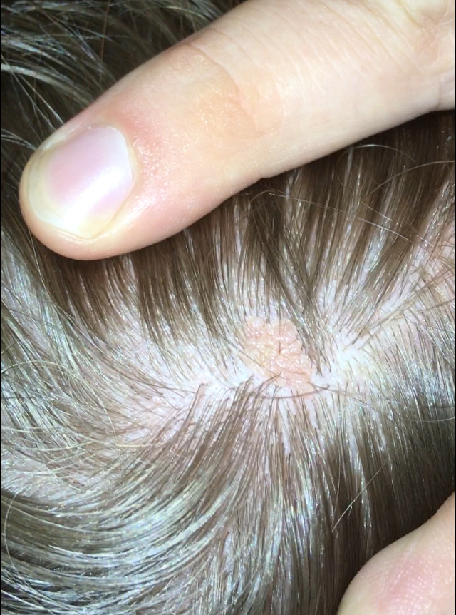 Sieht Das Wie Hautkrebs Aus Medizin Haut Hautarzt Sieht Das Wie Hautkrebs Aus Medizin Haut Hautarzt