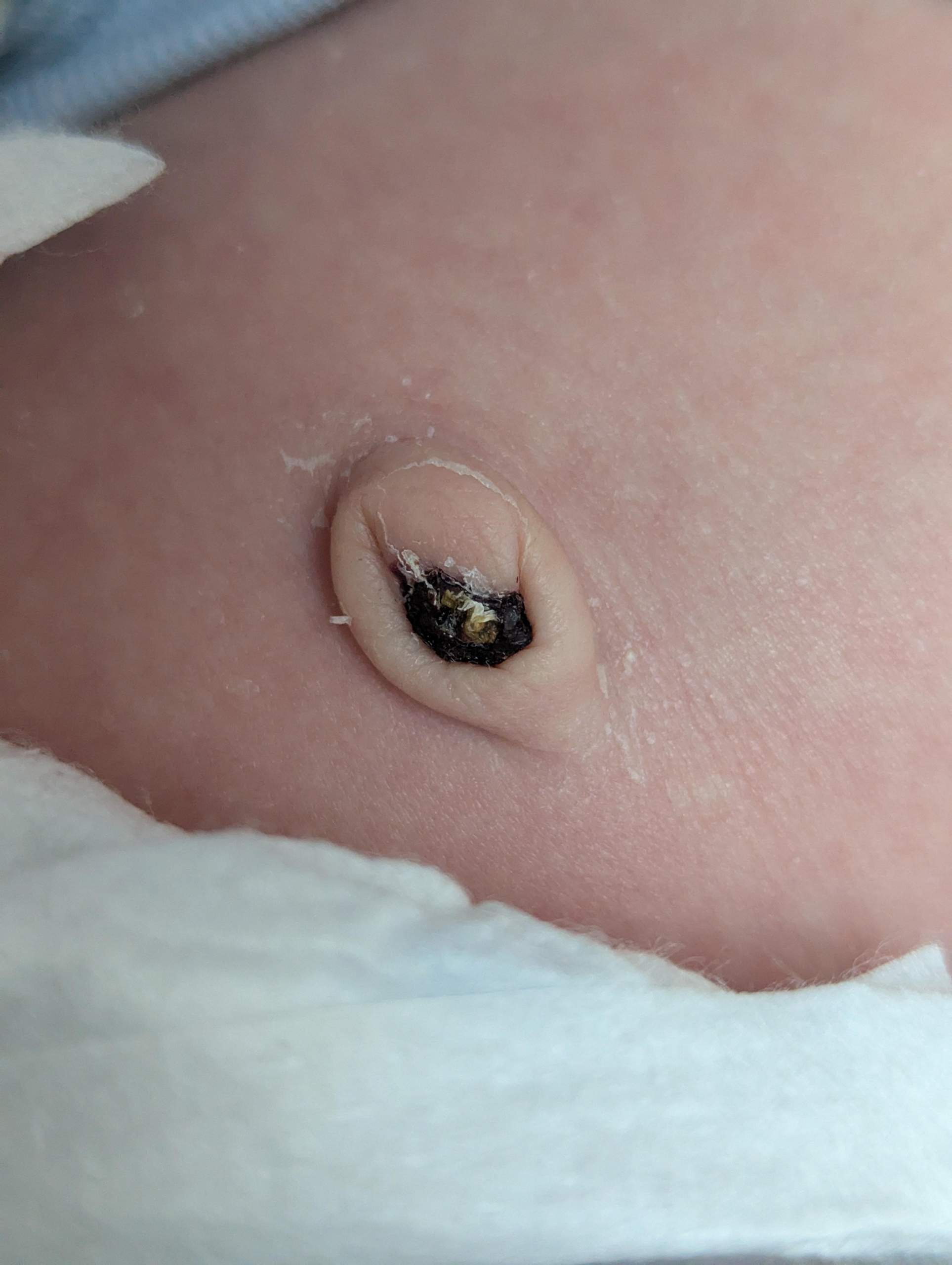 Sieht der Bauchnabel normal aus? (Hebamme, Neugeborenes, Nabelschnur)