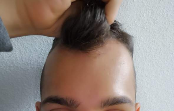 sieht der haarausfall bei mir arg aus