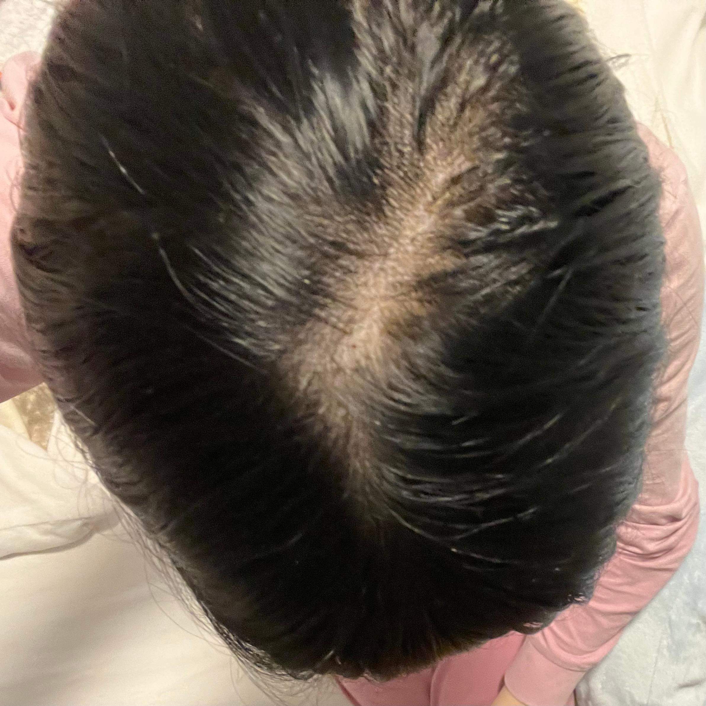 Sieht der Scheitel normal aus? (Haarpflege, Haarausfall, Haare färben)
